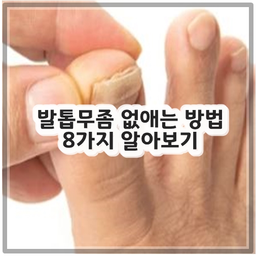 발톱무좀 없애는 방법 8가지 알아보기