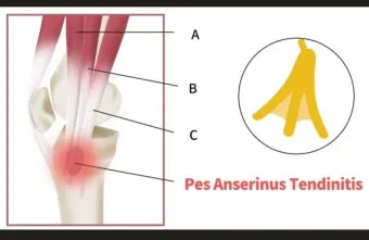 거위발 건염 원인과 증상 무릎 안쪽 통증 치료법 정리_40