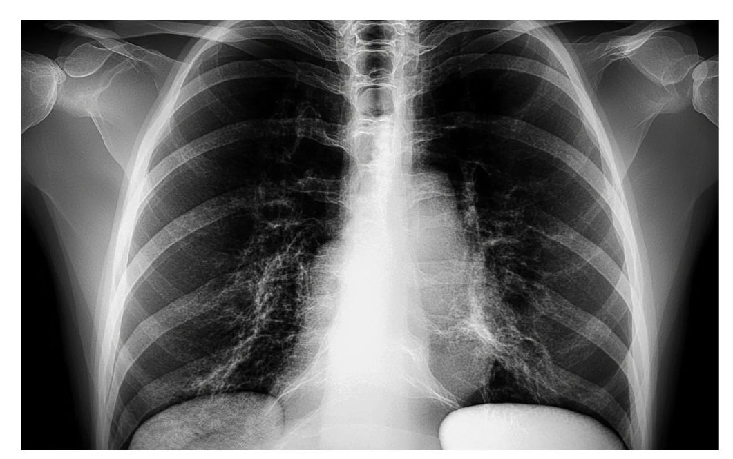 가슴 엑스레이 사진