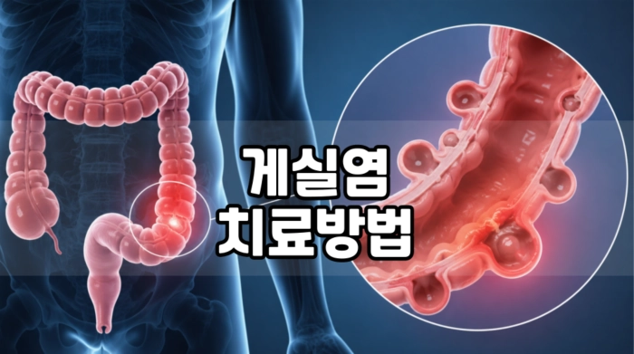 게실염 치료 방법