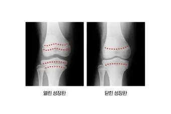 성장판 닫혀도 키 클 수 있는 방법과 성장 호르몬 시기_2