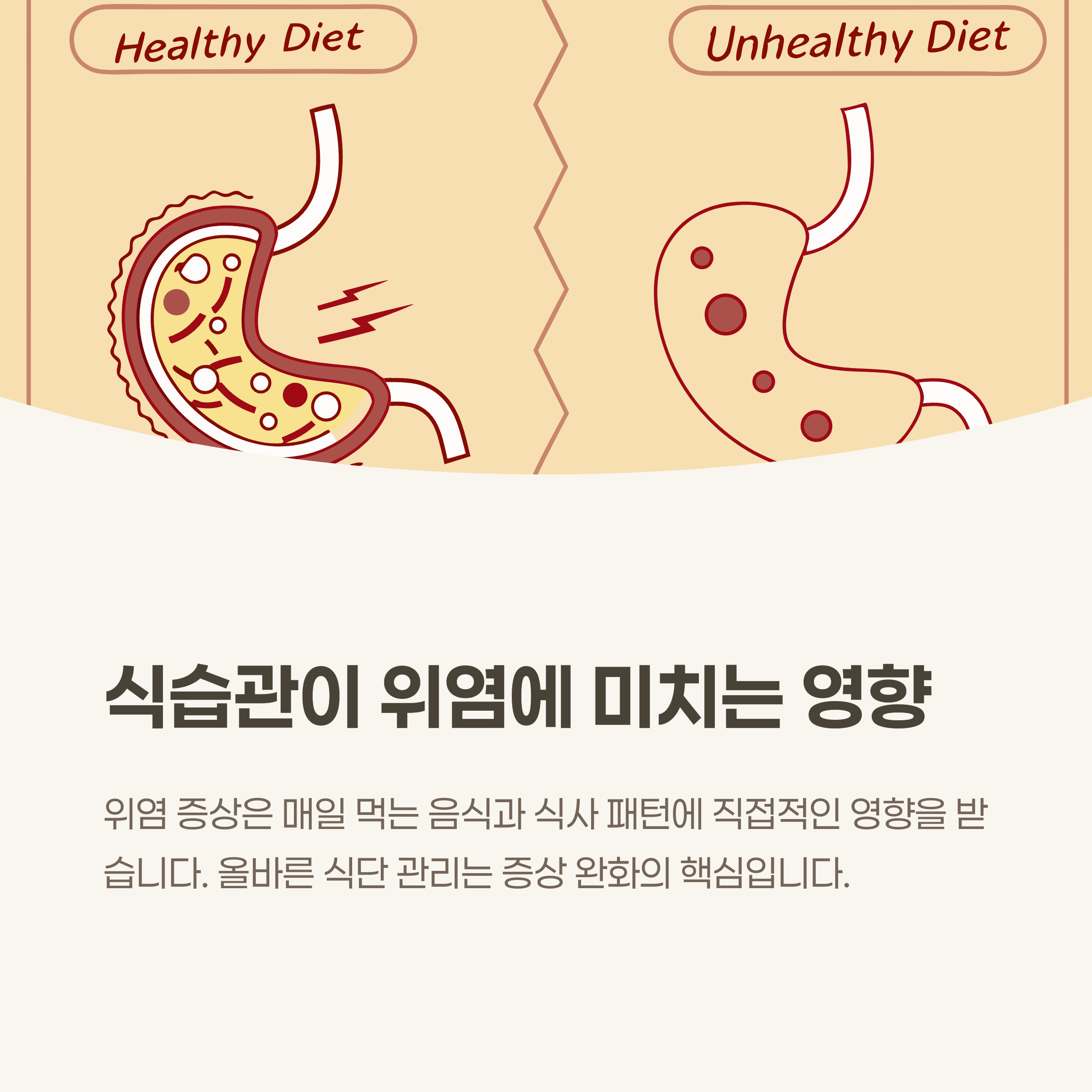 식단이 위염에 미치는 영향은 얼마나 클까요?