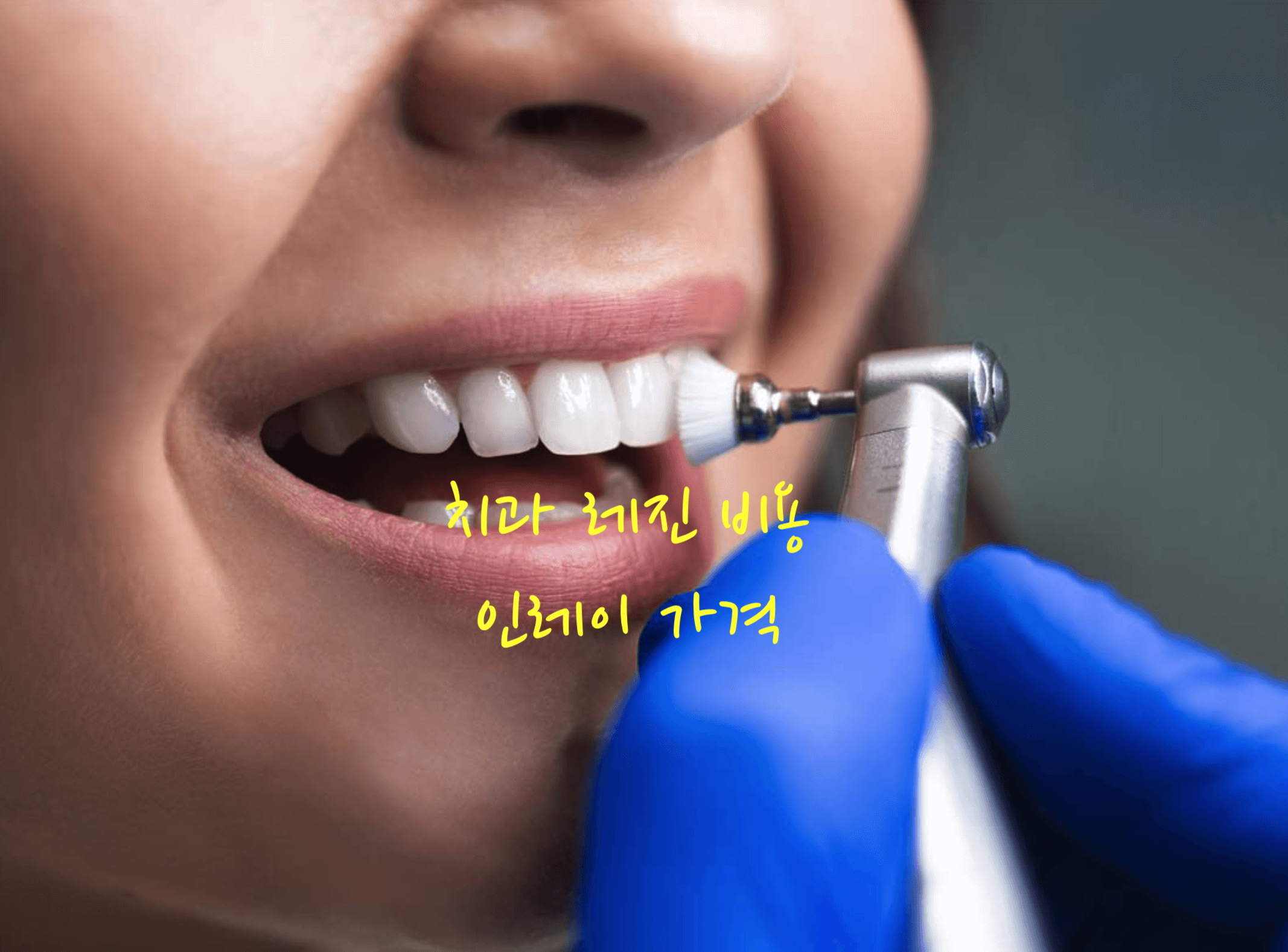 치과 레진 비용