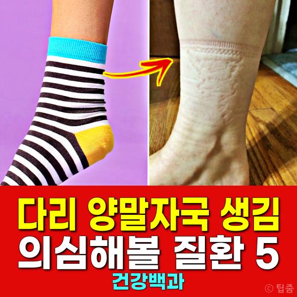 다리 양말자국 질환 코끼리다리 무다리 원인