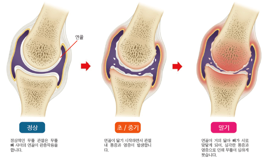 허벅지 근육과 무릎 연골 건강의 상관관계 관련 이미지