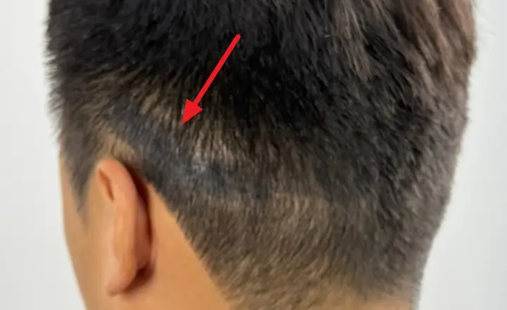 두피문신 부작용, 매직을 칠한 듯한 질감..