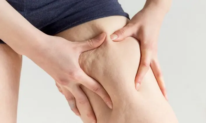 셀룰라이트 없애는 법 5가지