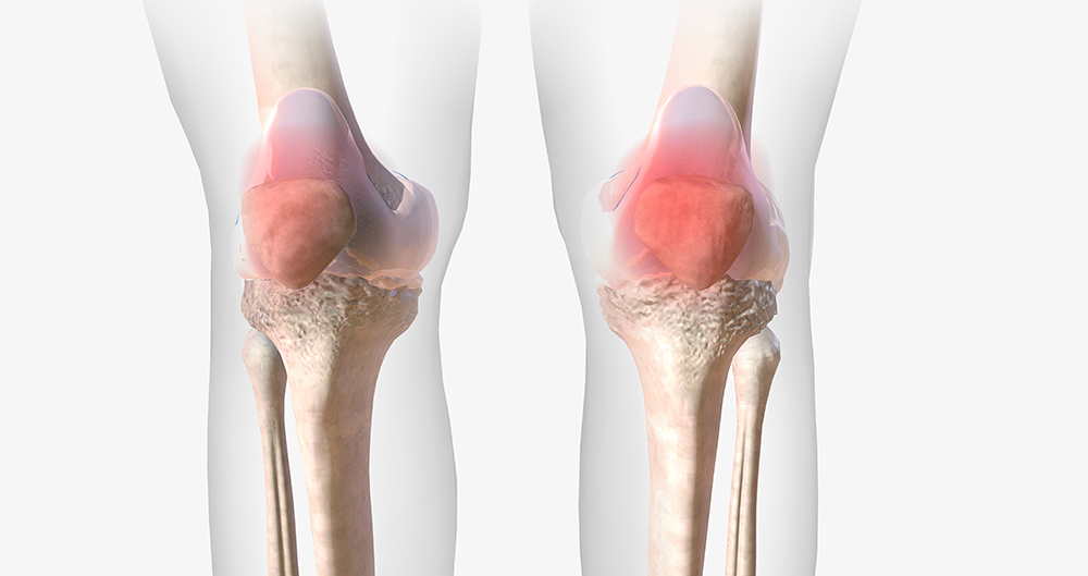 인공관절 수술비용