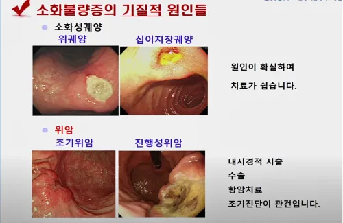 소화불량증의 기질적 원인들