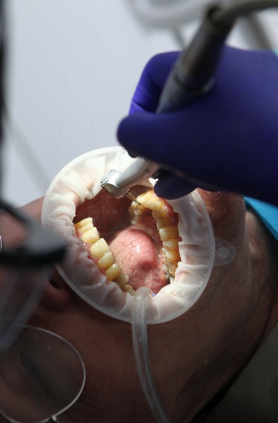 편도결석 제거법, 원인, 수술 총정리 (2024ver)