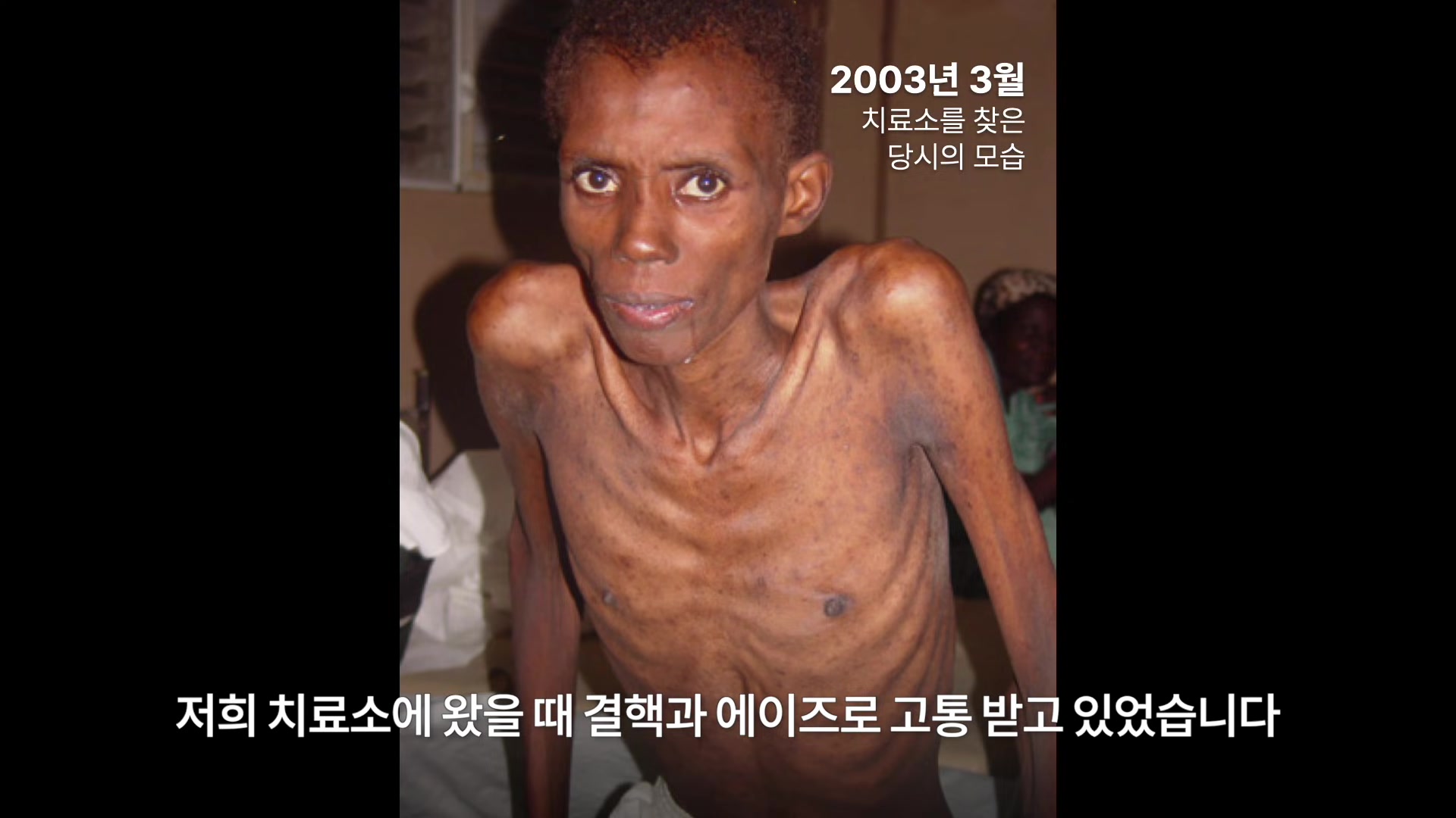 결핵과 에이즈 환자