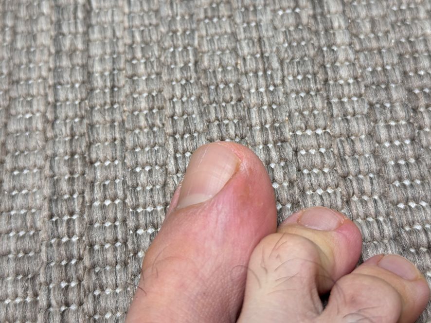 엄지발가락 엔드와츠 치료 결과 완치된 족저사마귀