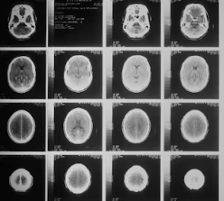 포스파티딜 세린 효능 음식 추천 부작용