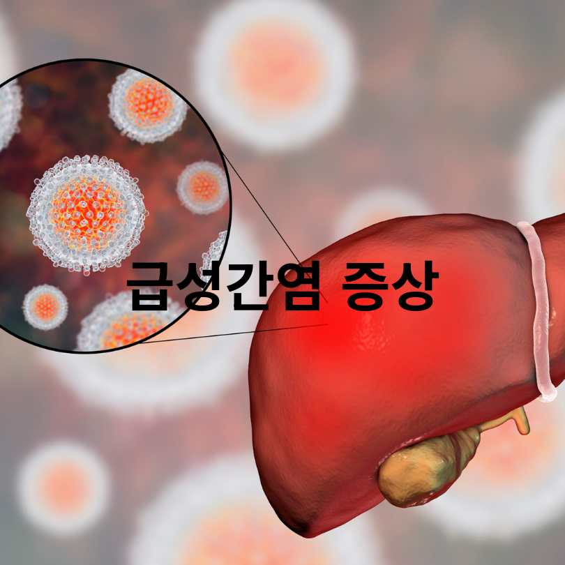급성간염 증상·원인·치료 총정리 (군 면제 정보 포함)