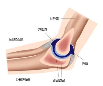 팔꿈치 통증 원인 6가지증상운동법예방법치료법까지_20