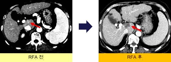 간암 라디오파 소작술