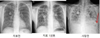 늑막에 물이 차는 이유와 치료 방법_9