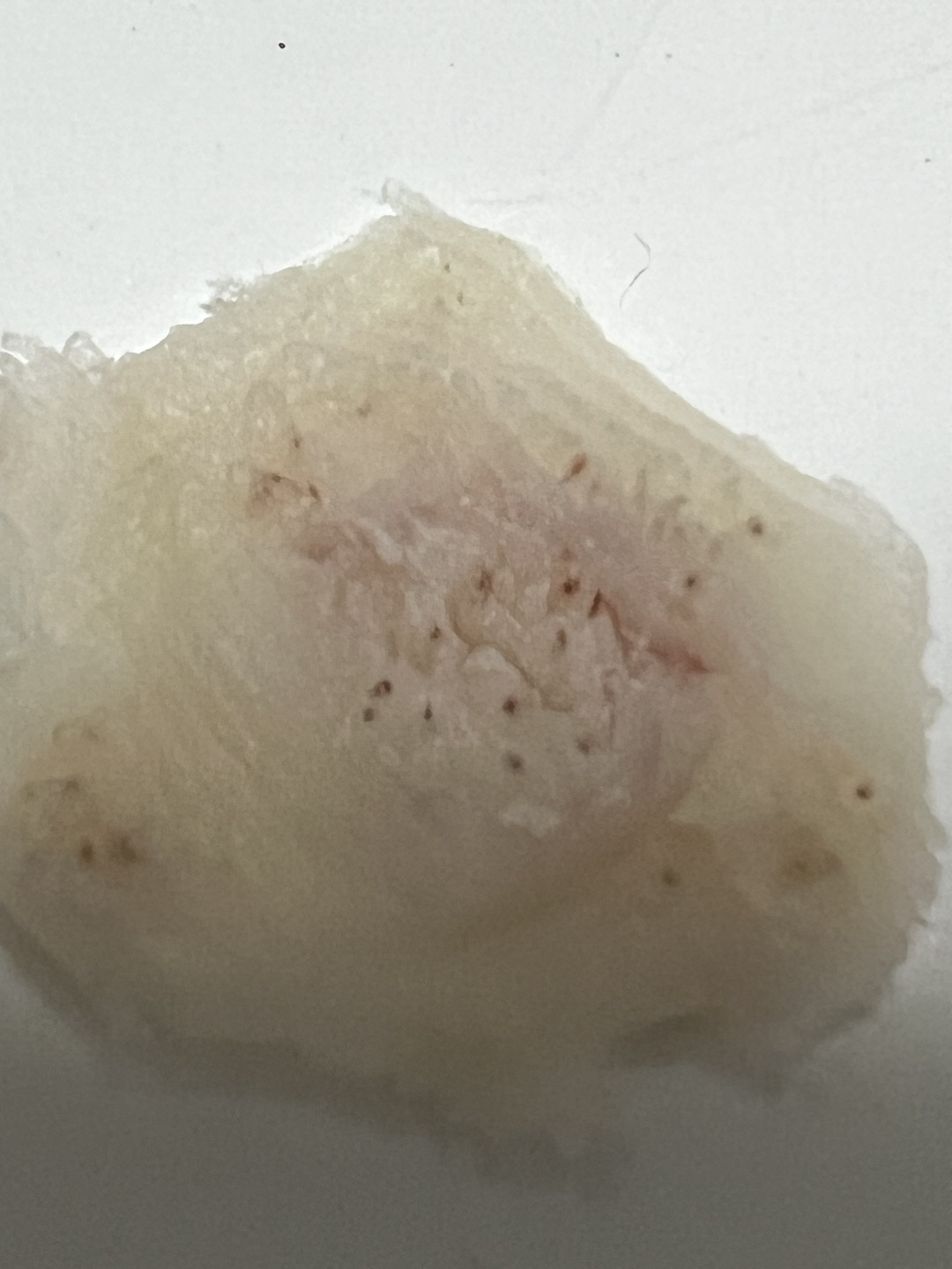 사마귀 점성출혈