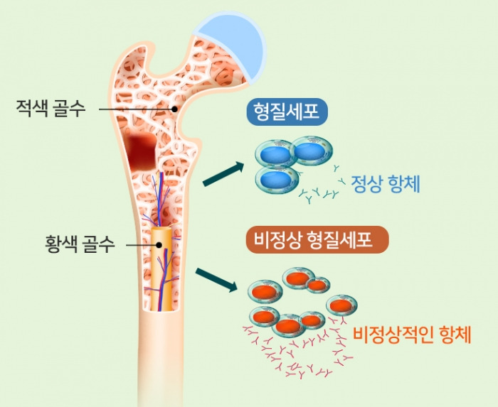 혈액암