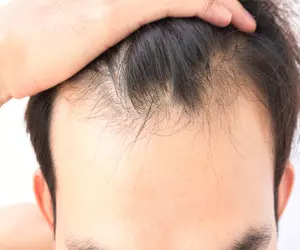 두피 가려움증