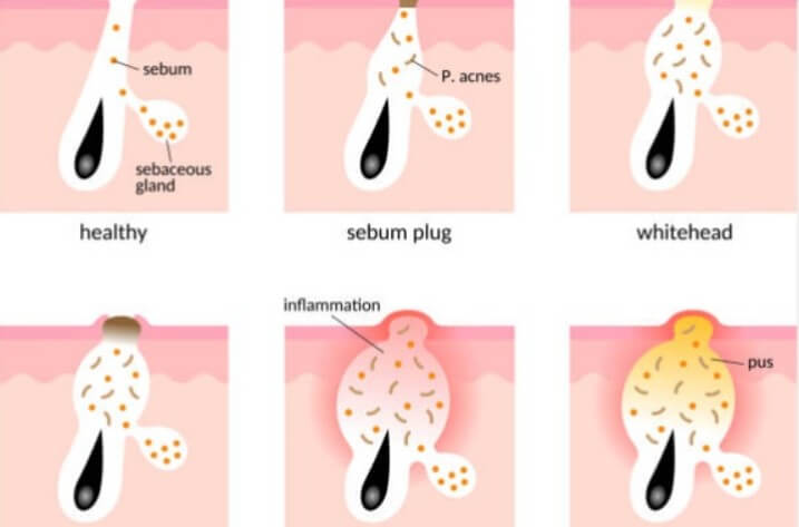 좁쌀 여드름 생기는 이유