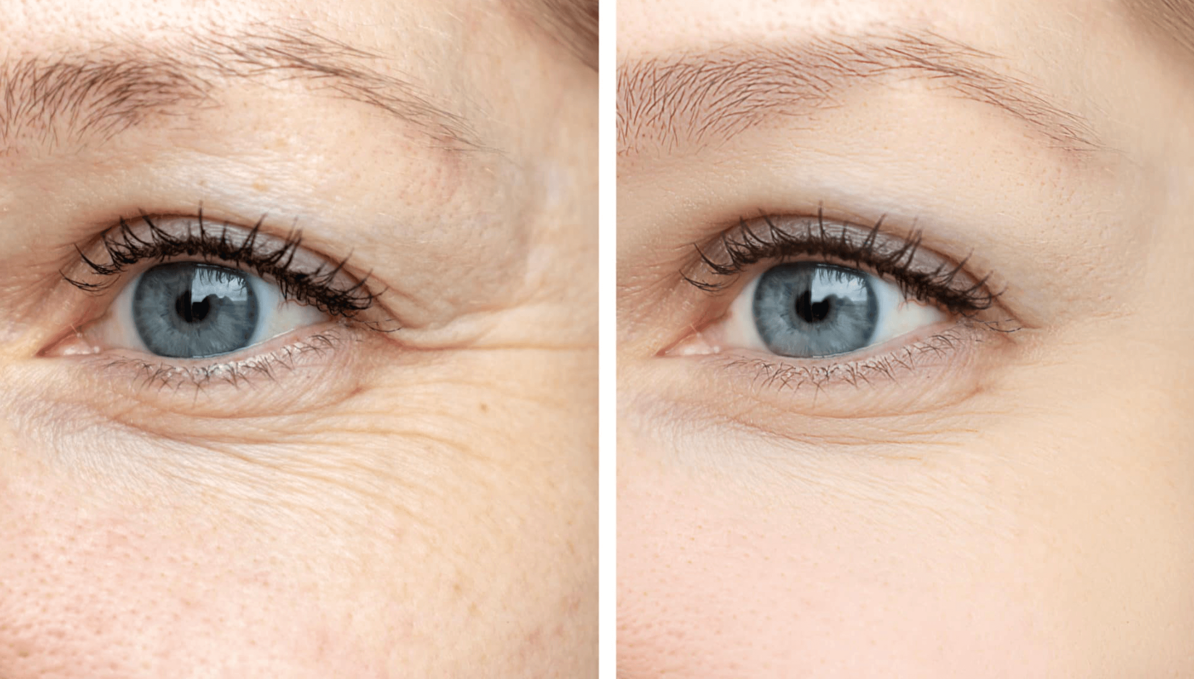 하안검-상안검후-눈주변-모습