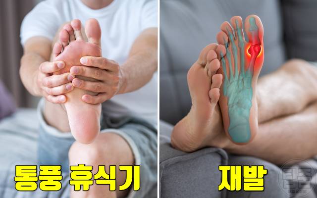통풍 초기증상 엄지발가락 통증 원인 통풍 증상 간헐적통증