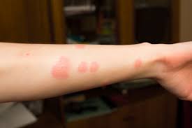 빈대 물린자국 : 빈대 퇴치법, 증상, 예방법