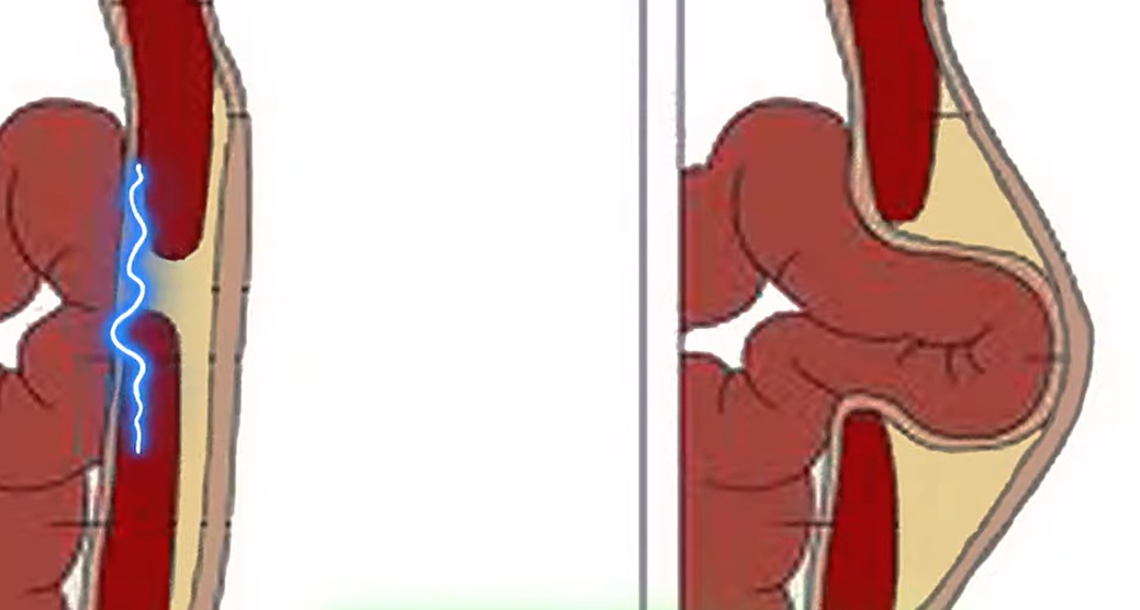 배꼽주위 통증