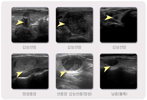각종 결절성 갑상선질환에서 감상선 초음파 검사 소견들