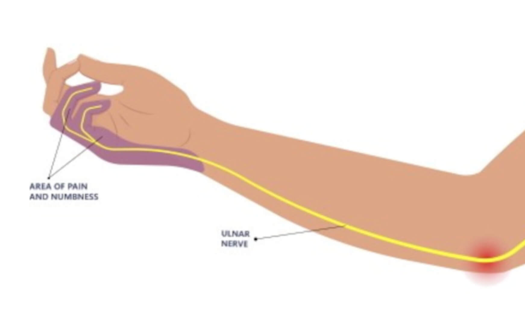 팔꿈치 터널 증후군 증상