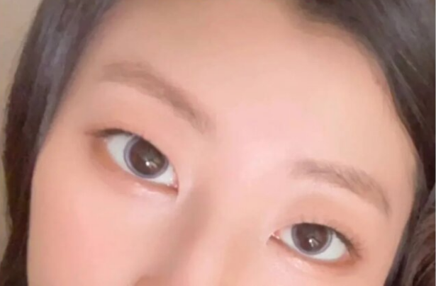 아이링수술, 아이링수술후기, 써클렌즈 대체, 눈동자확대수술, 미용성형, 안과 시술, 렌즈부작용