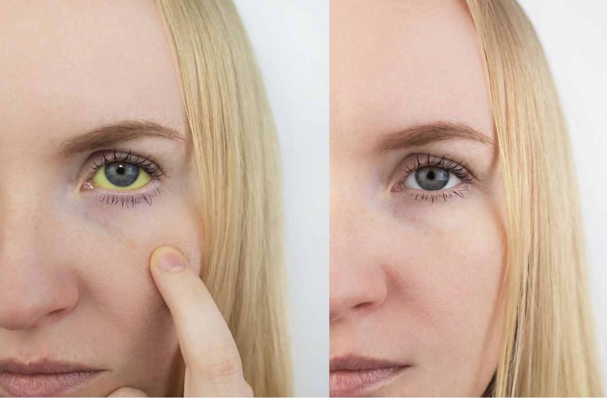 간경화 초기증상