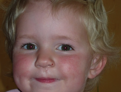 축농증에 걸려 콧물을 흘리는 아기