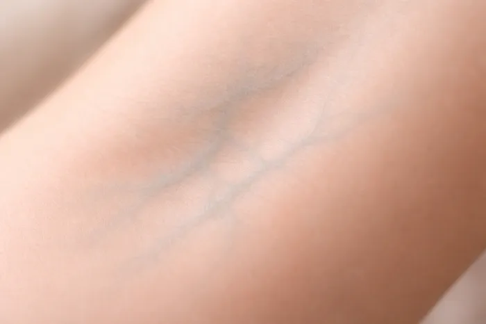피부에 멍이 잘드는 이유