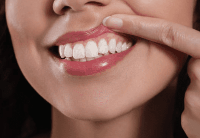 잇몸 염증 치료약