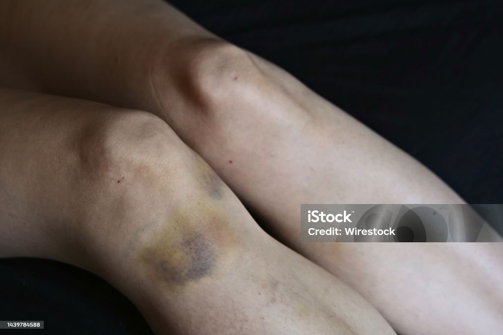 폴댄스 멍 빨리 없애는 방법 (회복 기간 줄이는 실제 관리법)