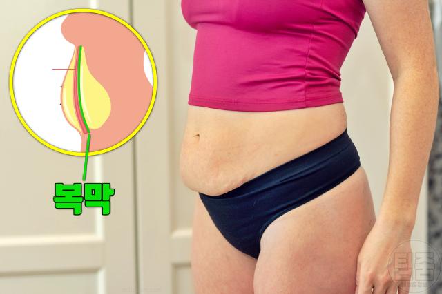 난소암 증상 전조증상 복부팽만