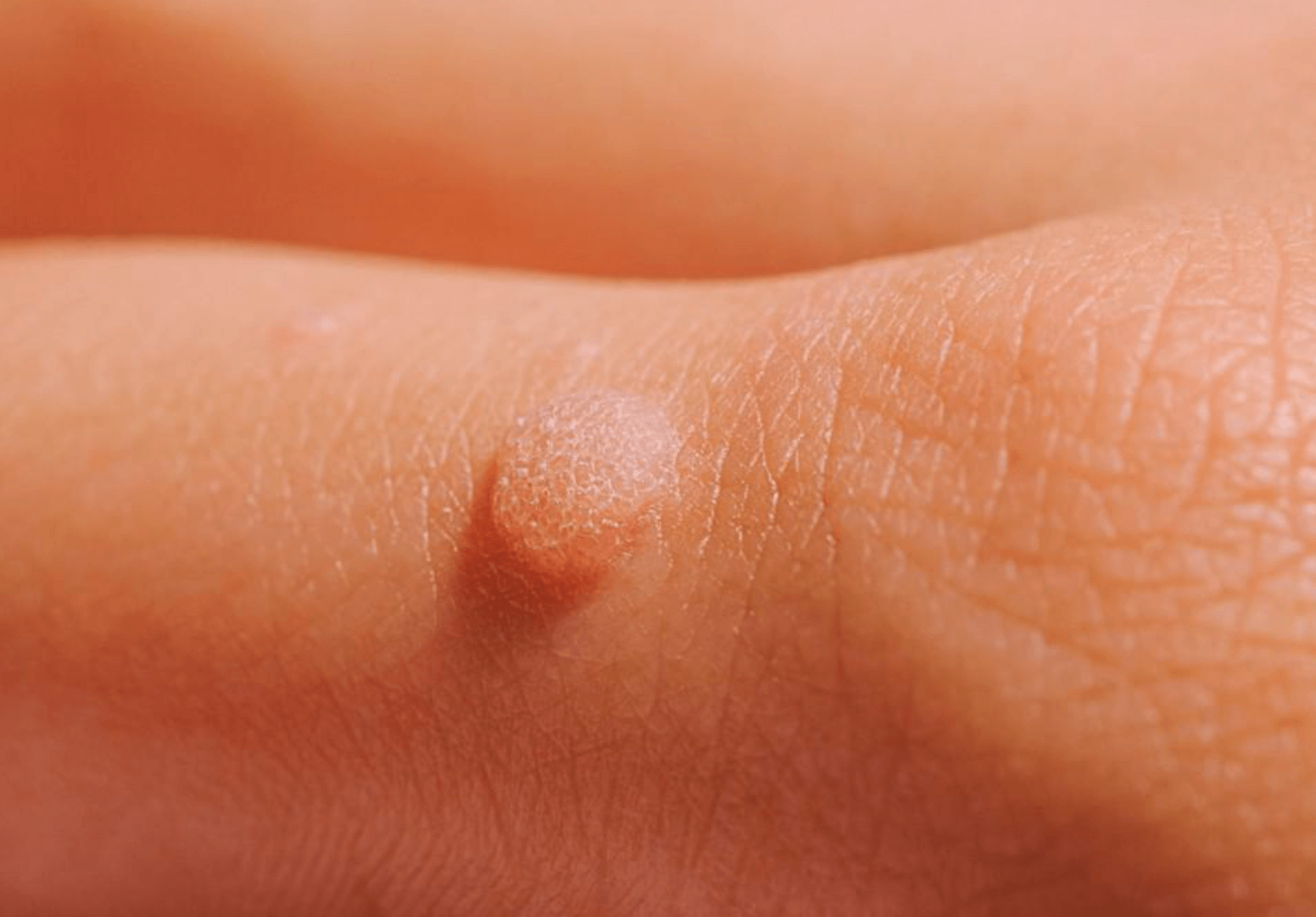 티눈 제거 방법