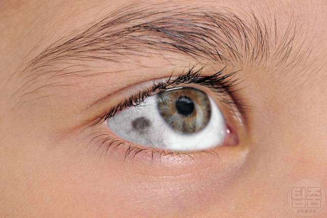 피부암 호발 부위 피부암자가진단 눈흰자