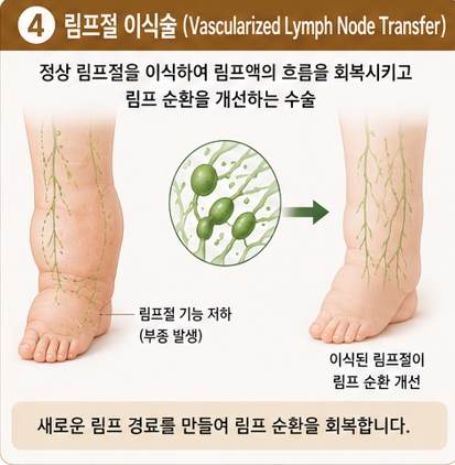 림프절 이식술