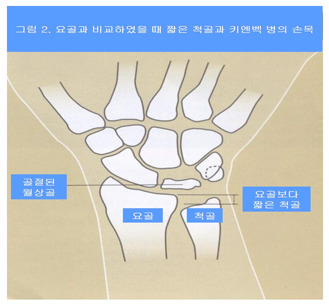 키엔백 병 출처 대한 정형외과 학회 훔페이지