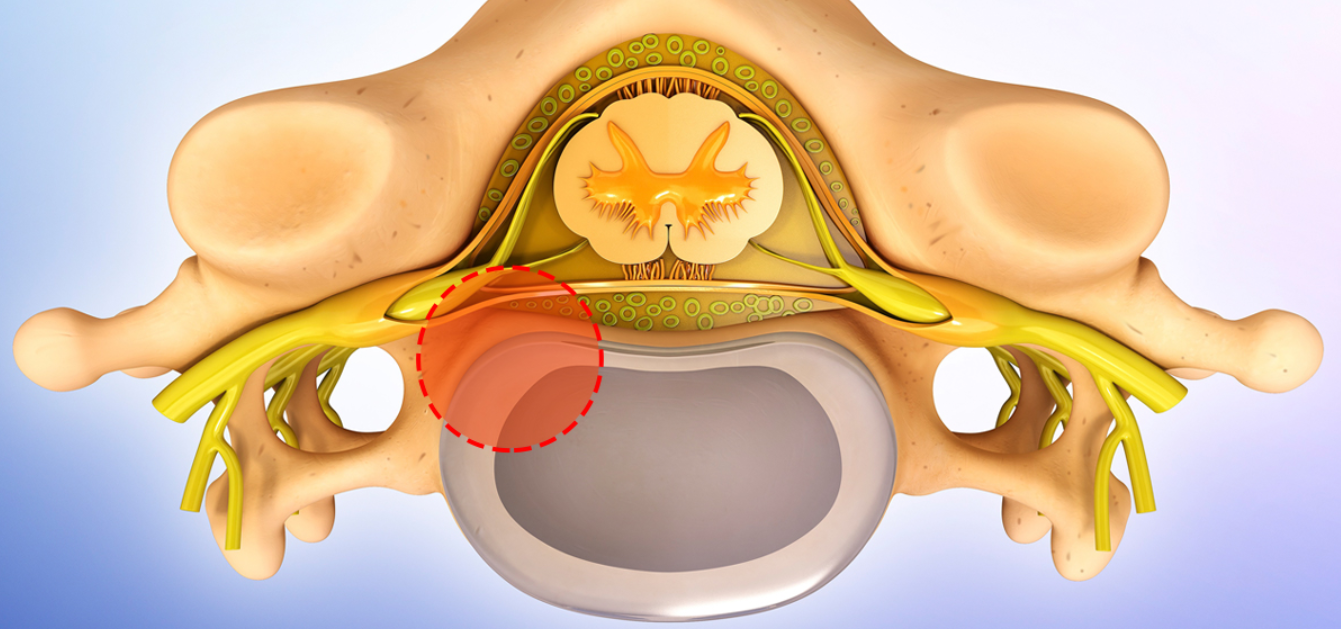 고주파 수핵성형술 치료 이미지