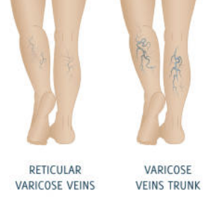 하지정맥류 증상 수술비용 좋은운동 등 총정리(2024 최신)