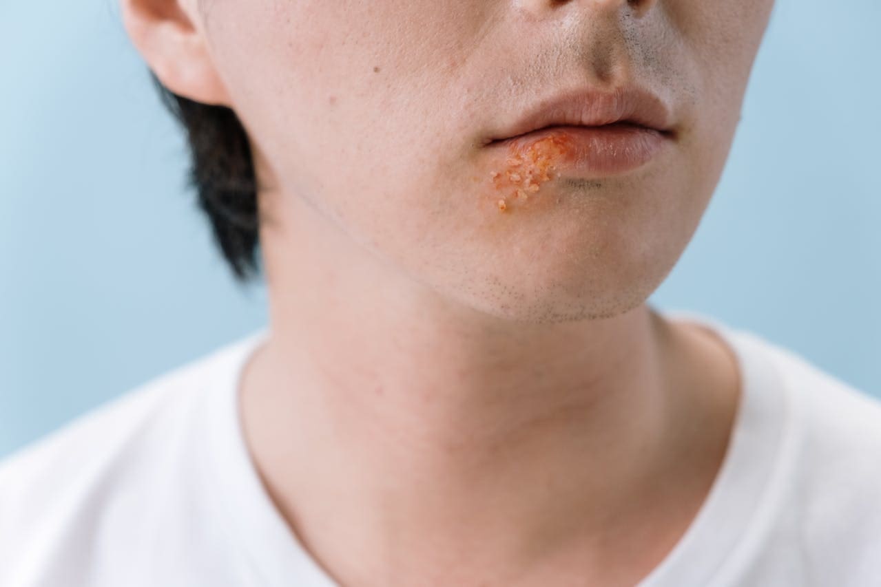 대상포진 초기 증상, 원인, 치료, 전염성, 가족 간 감염 예방 자주 묻는 질문