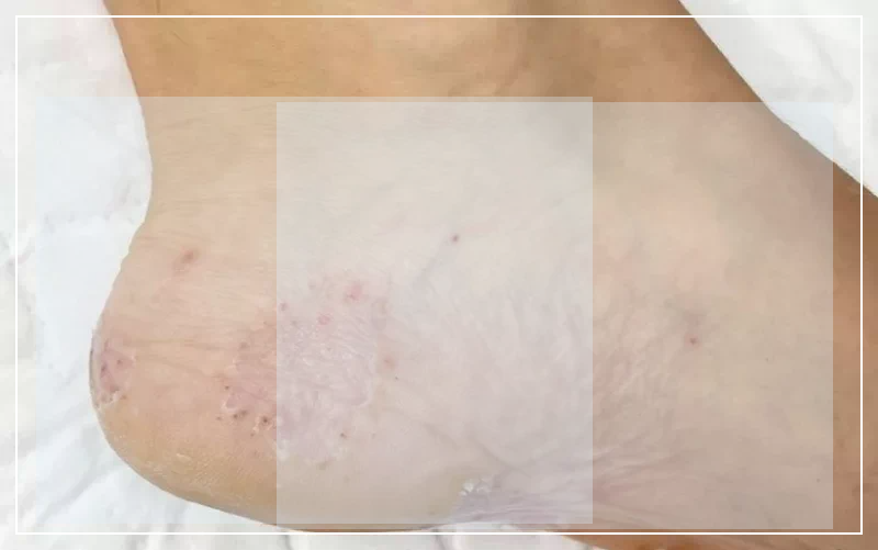 만성 각화형 무좀