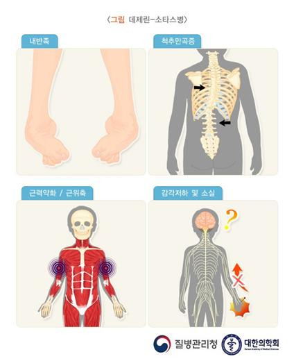 데제린-소타스병(Déjerine-Sottas disease)