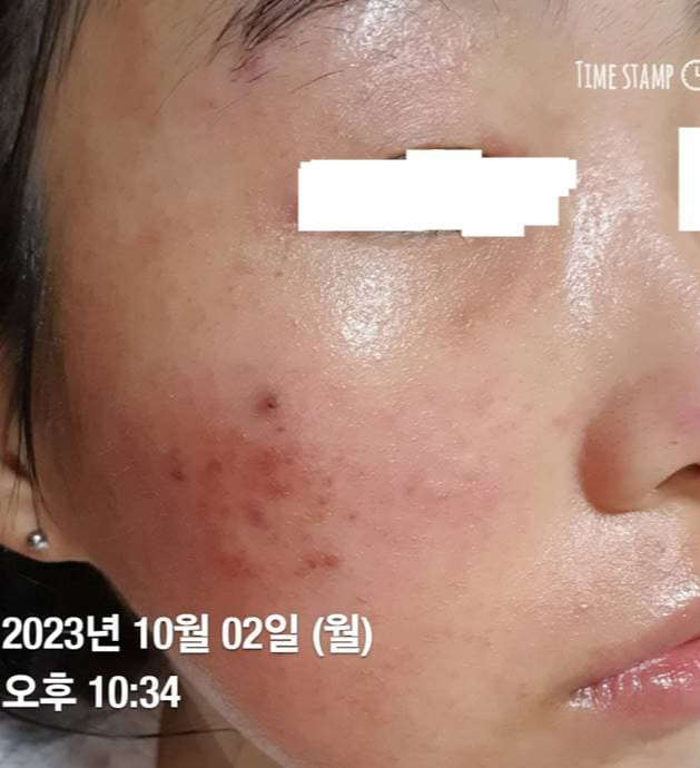 얼굴 피부염
