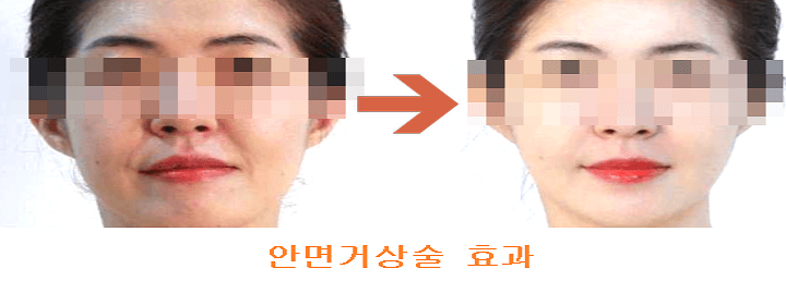 수술하기 전과 후 사진
