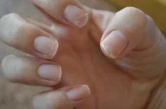 손톱이 갈라지는 이유 원인 증상 대처법_24